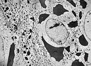 F,46y. | large keratohyalin granules in epidermal cells - verruca vulgaris